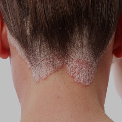 psoriasi5