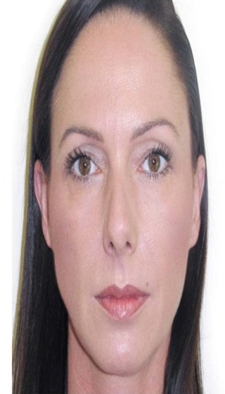 botox volos after