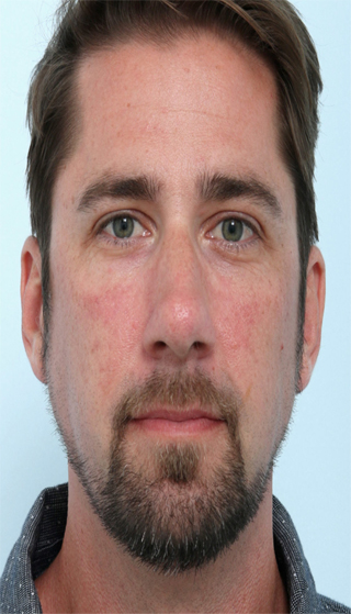 Laser Genesis after